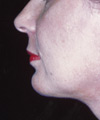 Chin Surgery - After