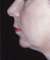 Chin Surgery - Before