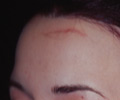 Scar Revision - Before